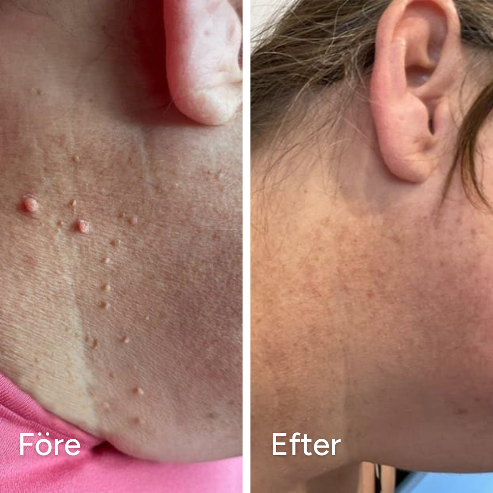 DermaPatches - Bli av med hudflikar smärtfritt